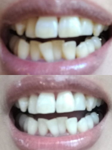 ホワイトニング東京効果